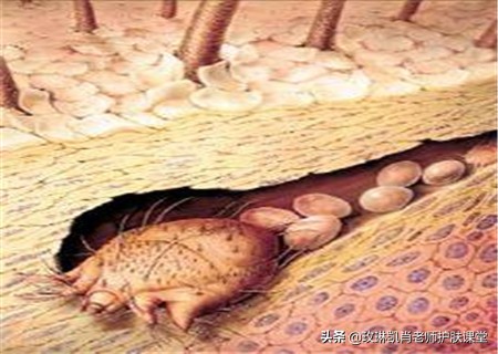 全身被螨虫咬怎么解决,人被螨虫感染了是什么症状