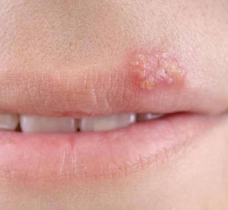 嘴边上火起泡结痂变红要多久能好,嘴角起泡是病毒感染还是细菌感染