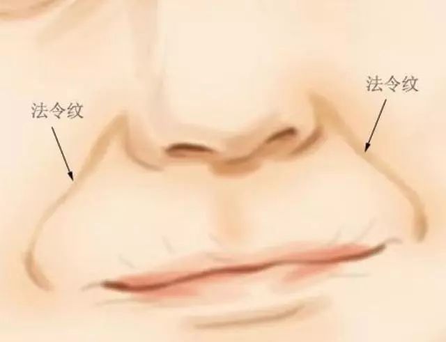 脸垮法令纹深最省钱的办法,脸垮了法令纹该怎么办