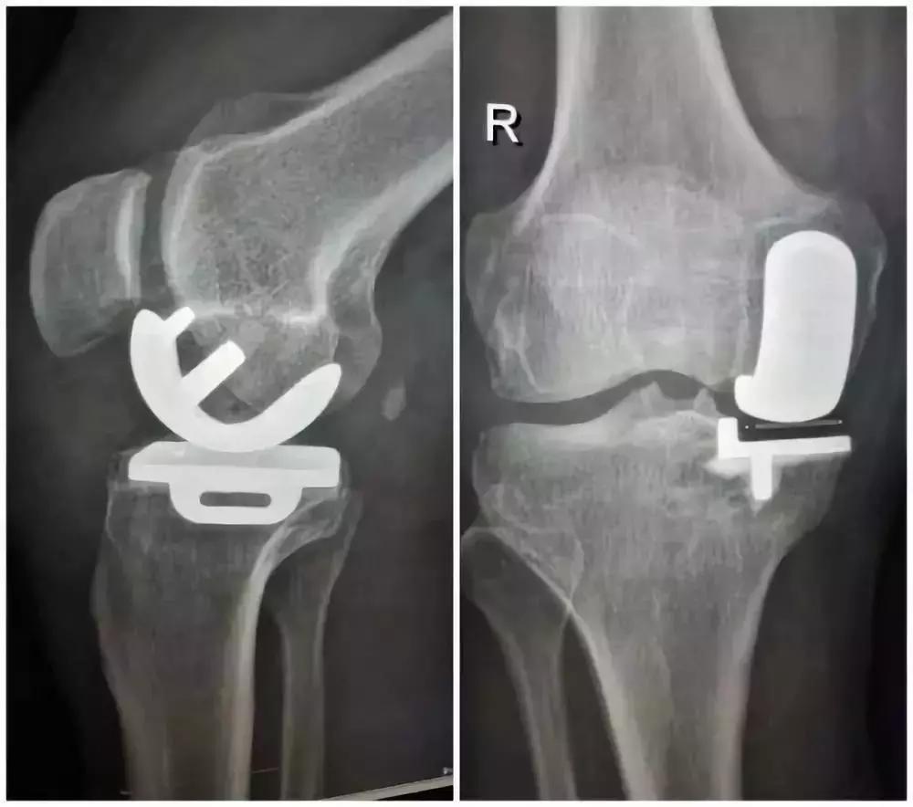 老年人膝关节疼痛蹲下不能站起,老年人膝关节伸不直加疼痛