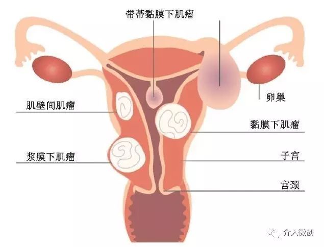 子宫肌瘤6cm可以怀孕吗,当怀孕遇到了乙肝该怎么办