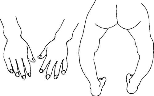 佝偻病是因为缺钙吗,孩子佝偻病是咋回事