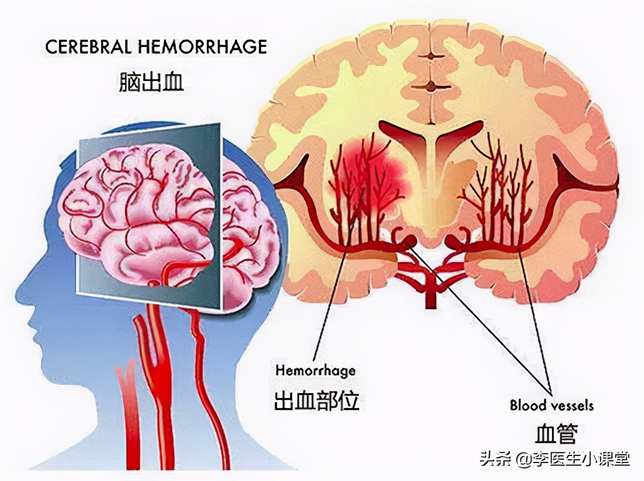 家人突发脑出血咋办？医生教你几个家庭急救办法，关键时候能救命