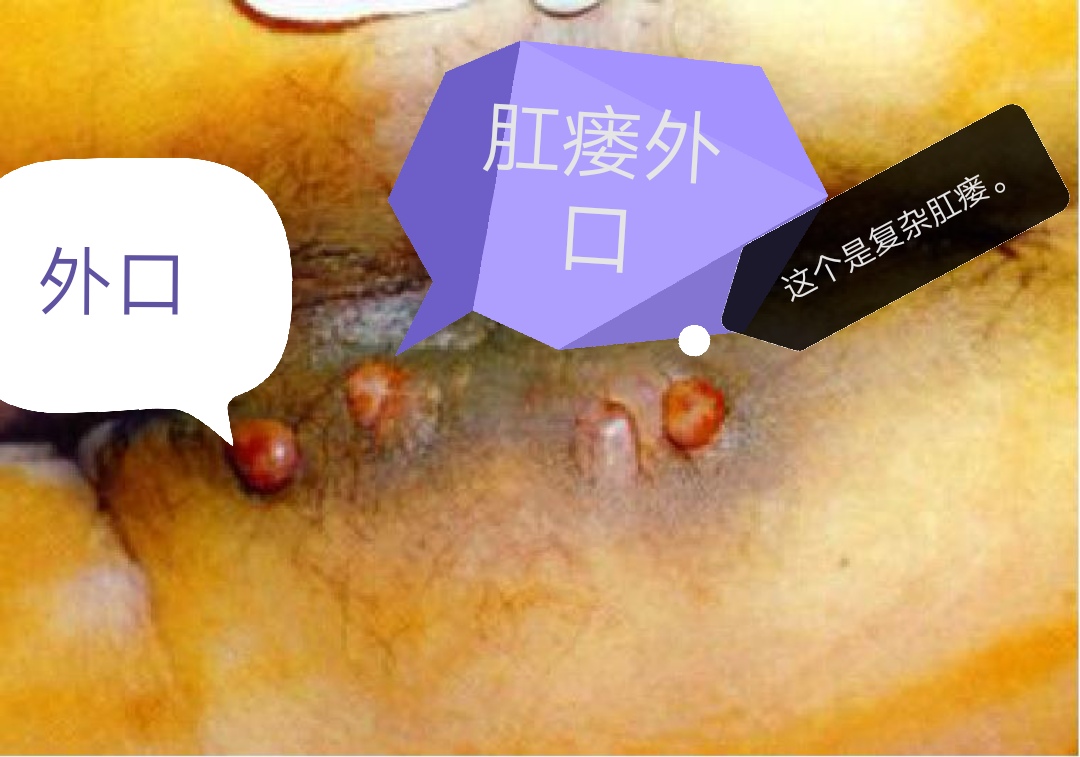 肛瘘手术切口肉挖空了怎么回事,肛瘘手术当天要不要人照顾