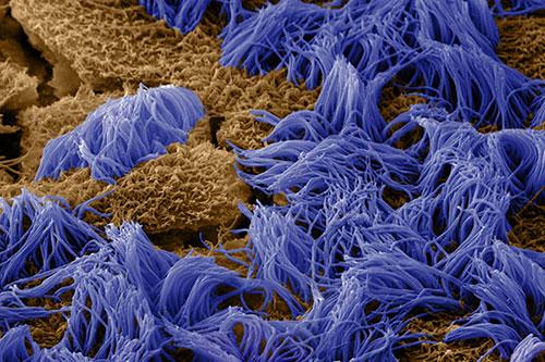 深度解读肺炎黏液|对于新冠肺炎的治疗的一些参考意见