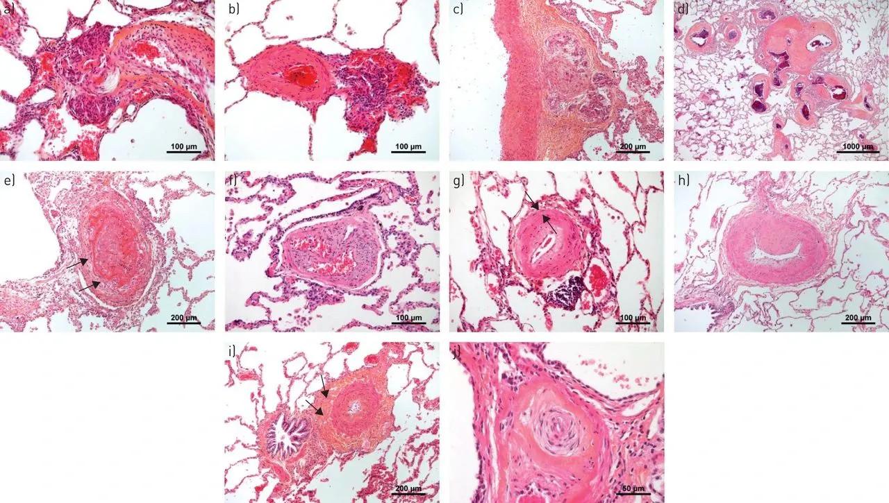 先天性心脏病主动脉与肺动脉,先天性心脏病肺动脉高压的表现
