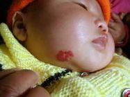 大面积婴儿血管瘤,婴幼儿血管瘤的危险因素