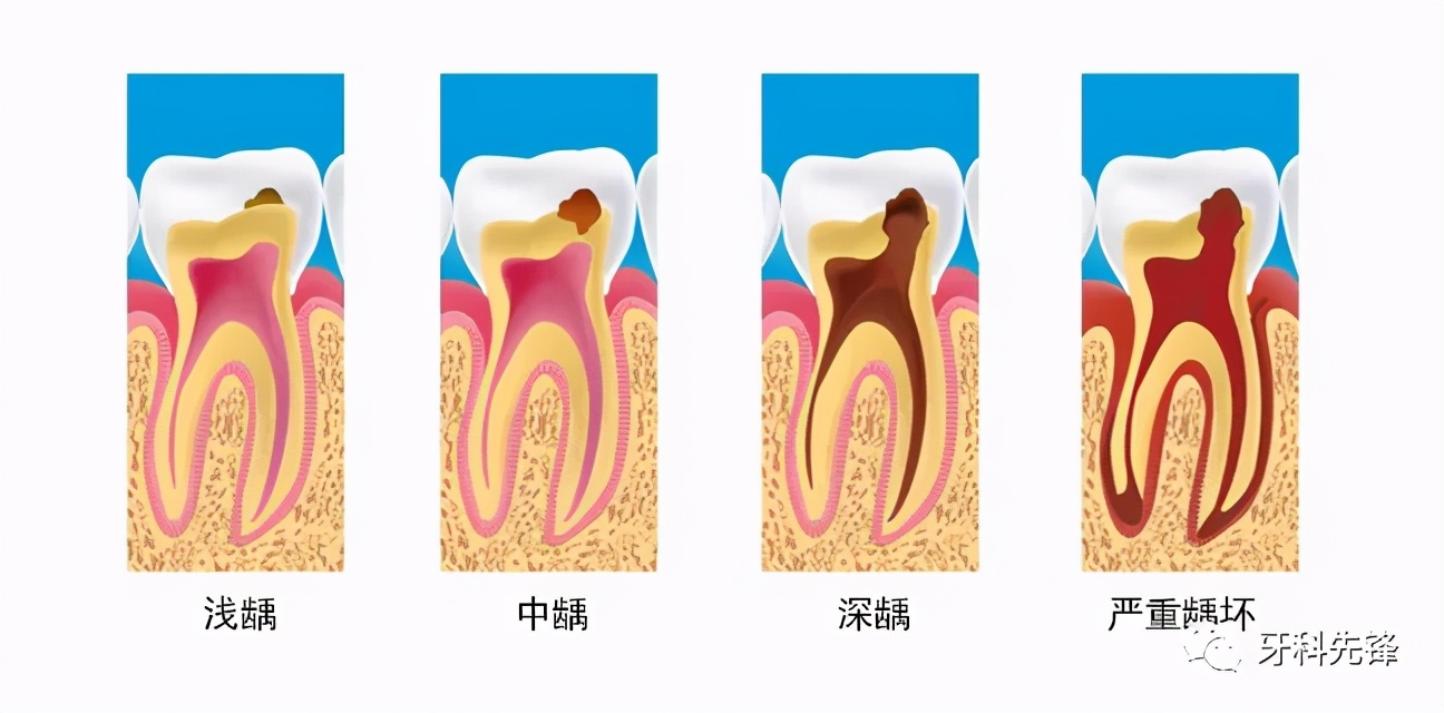 牙齿的普通治疗与根管治疗,根管治疗最严重的牙齿