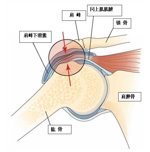 肩膀疼痛怎么康复锻炼最有效,健身后肩膀骨头凸起疼痛