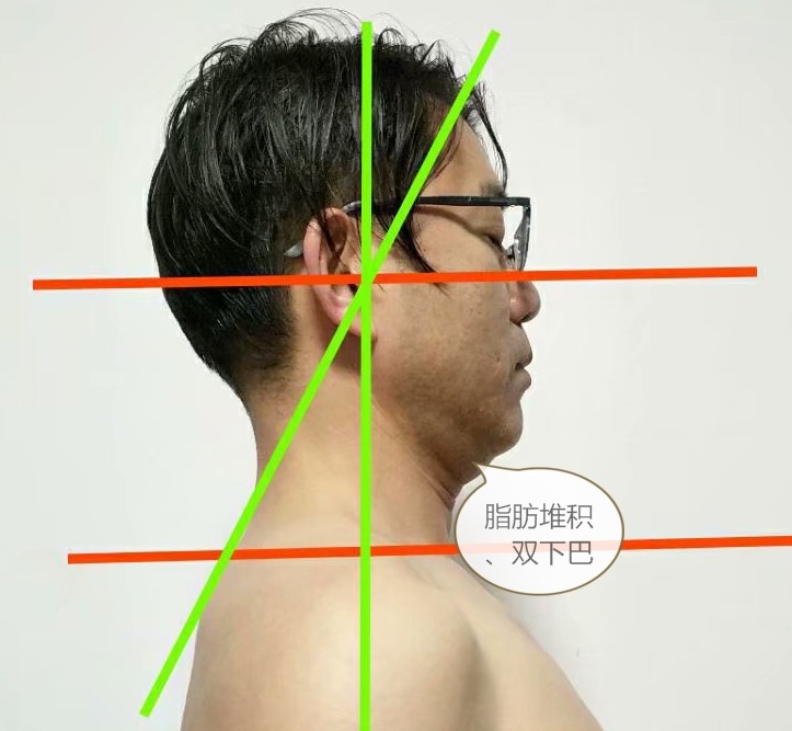 双下巴上有一坨肉向外凸,下巴多了一坨肉往前翘是太胖了吗