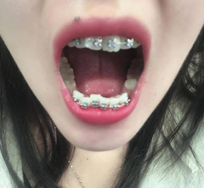 牙套隐形日记,牙套日记正颌