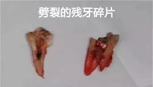 蛀牙了十几年还需要做根管治疗吗,蛀牙了一个小洞要根管治疗吗