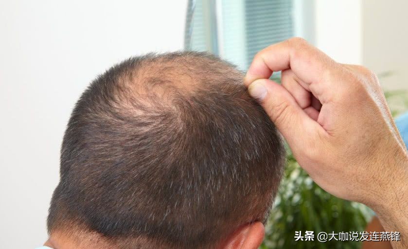 发量少细软适合什么发型免打理,头发稀少发质软塌怎么打理