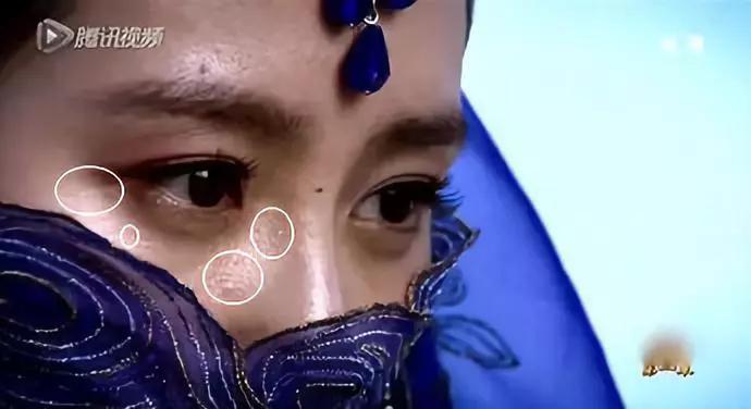 别再用针挑！用米澳拉，脂肪粒自己“掉”下来，效果胜过医美激光