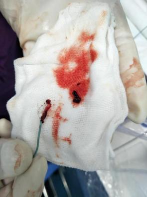 脑血管的清道夫——神奇取栓术