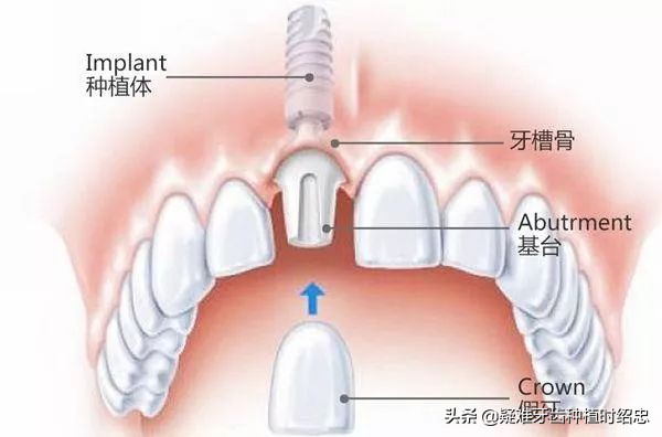 做种植牙必须要具备这些条件,种植牙的缺点哪些人不适合种植牙