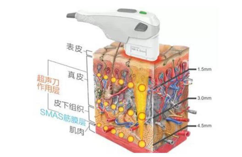 热玛吉抗衰技术可靠吗,超声炮和热玛吉哪个抗衰效果好