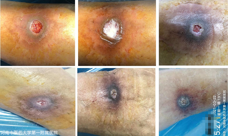 老烂腿的最佳治疗方法,老烂腿伤口不愈合用什么药