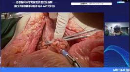 胃肠肿瘤外科,胃肠外科最新直播