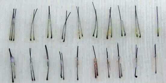 发根从毛囊里掉了还会长出来吗,毛囊有小白点是坏死吗