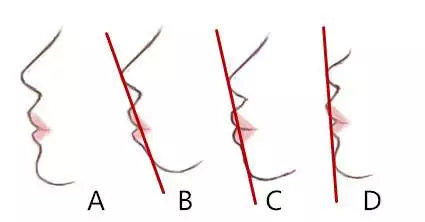 露龈笑太丑了该怎么办,露龈笑除了戴牙套有别的办法吗