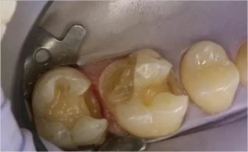 关于牙齿龋坏的小问答,牙齿掉了一半怎么补牙最好