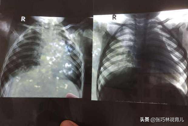 两岁宝宝肺炎支原体感染反复咳嗽,孩子得了支原体肺炎怎么去护理