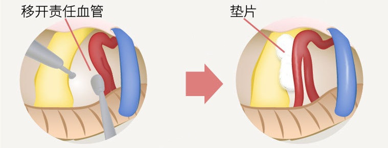 彻底根除三叉神经痛不花一分钱,三叉神经痛的最佳治疗方法