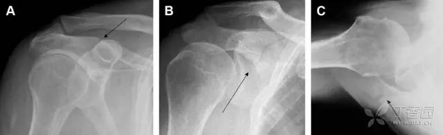放射科夜班病例大全,放射科容易漏诊的骨折