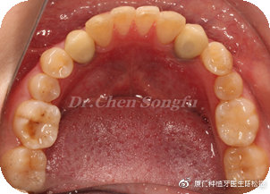 厦门种植牙陈松福,口腔正畸案例分享