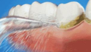 洗牙后不上药有关系吗,洗牙后不封釉有关系吗