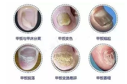 得了灰指甲如何避免传染,一个灰指甲传染两个灰指甲