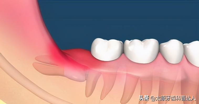 牙龈肿痛发炎是哪个脏腑引起的,十大常见牙龈疾病