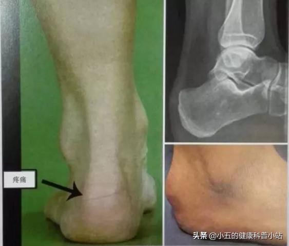 足跟痛是一个疾病征兆,足跟痛是什么疾病的前兆