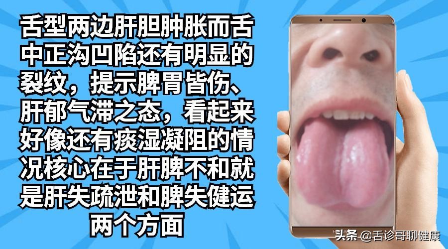 舌诊哥说亚健康,抖音舌诊哥舌象分析与感悟