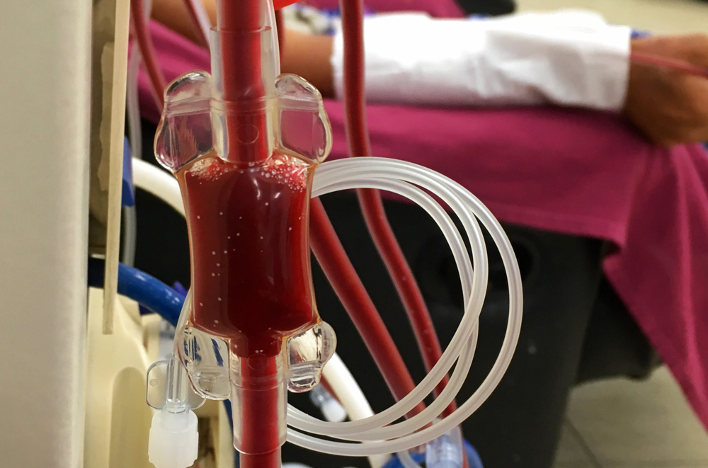 冠心病造影和心梗造影一样吗,查出冠心病有必要做心脏造影吗