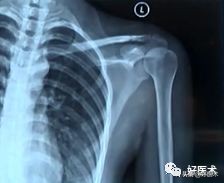 肩锁关节脱位手术后多久可以喝酒,肩锁关节脱位钢板内固定步骤记录