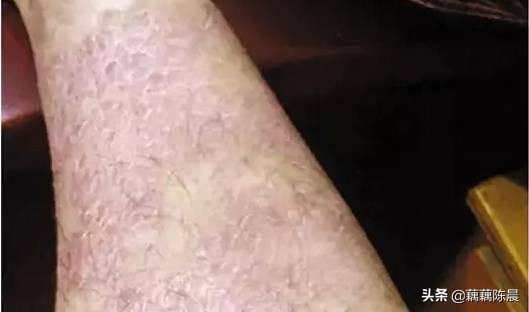 癌的早期信号!医生呼吁:早知道能救命!