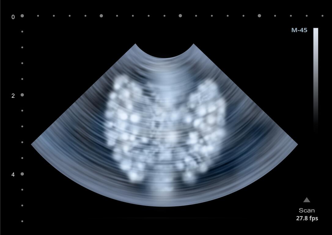 女性一阵发热是咋回事,女子连续3天发热39度以上