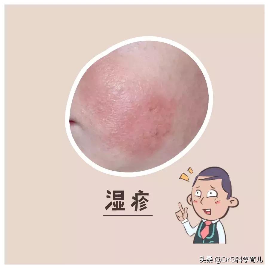 天气热了长痱子怎样快速解决,天热身上起痱子有特效药吗