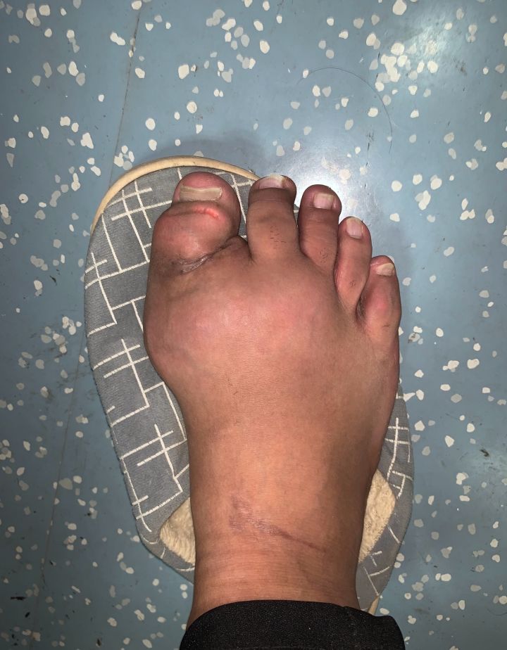 脚大拇外翻和痛风有什么区别,大脚趾痛风和拇外翻的区别