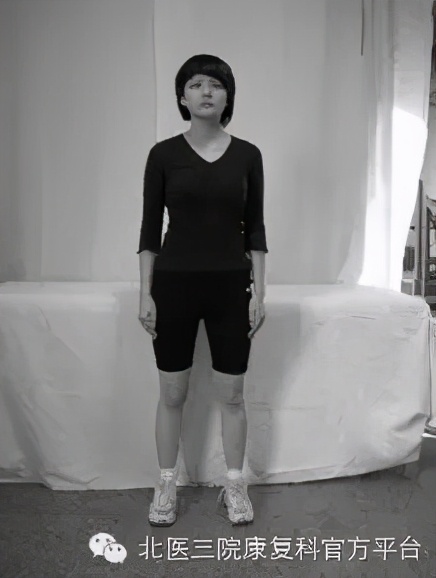 髋关节撞击综合征微创手术恢复,关节镜微创术半月板修复后康复