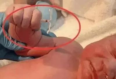 带环怀孕畸形的有吗,带环怀孕一定是宫外孕吗