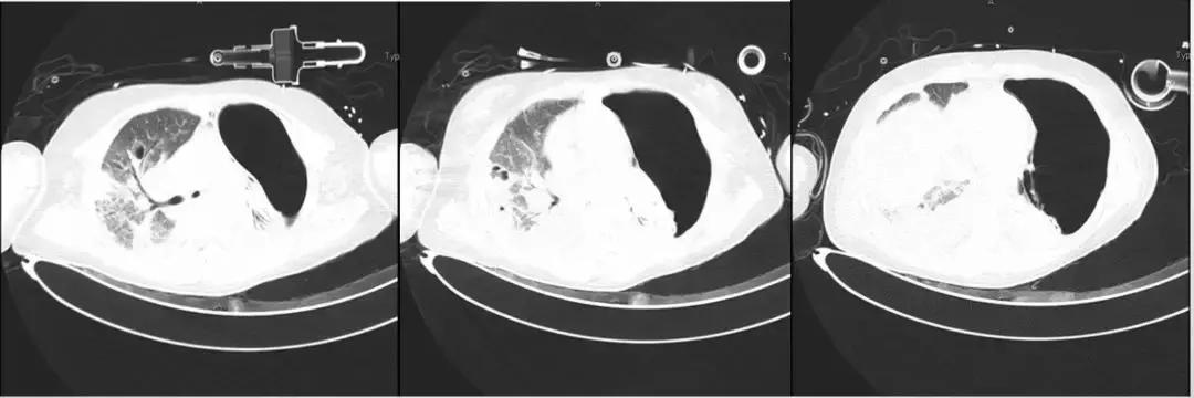 万古霉素治疗mrsa疗程,万古霉素用于mrsa的作用机制