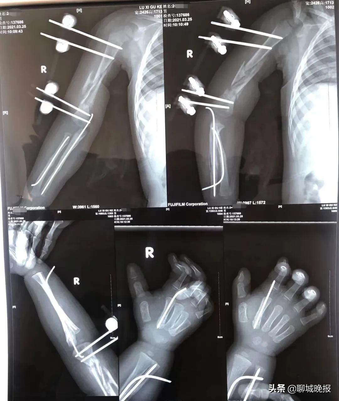 一岁多的聊城娃,牵动多地名医心