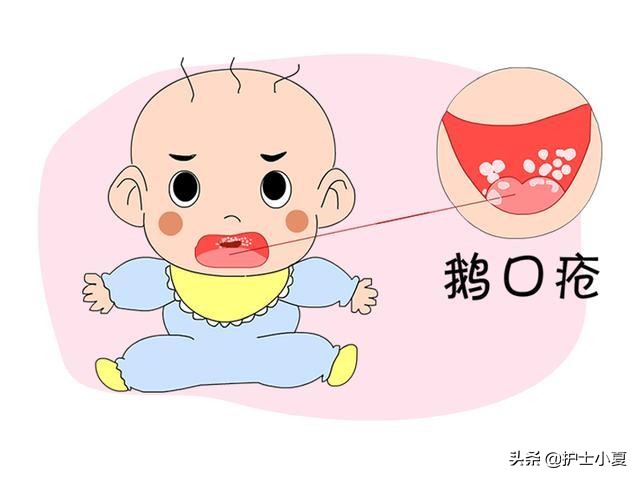 宝宝口腔白斑鹅口疮怎么治疗,宝宝鹅口疮需要将白斑擦掉么