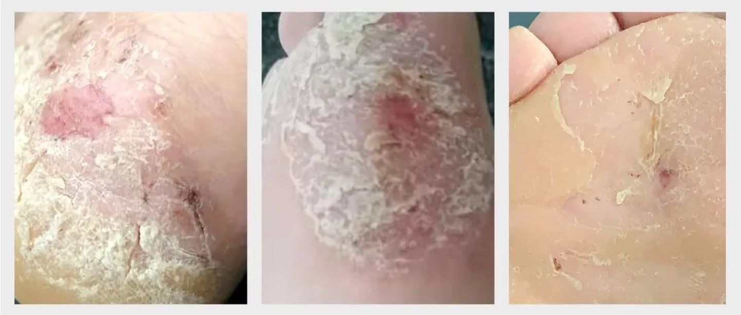 脚气脚臭脚痒的治疗方法小妙招,有脚臭脚痒裂口的脚气症状怎么治