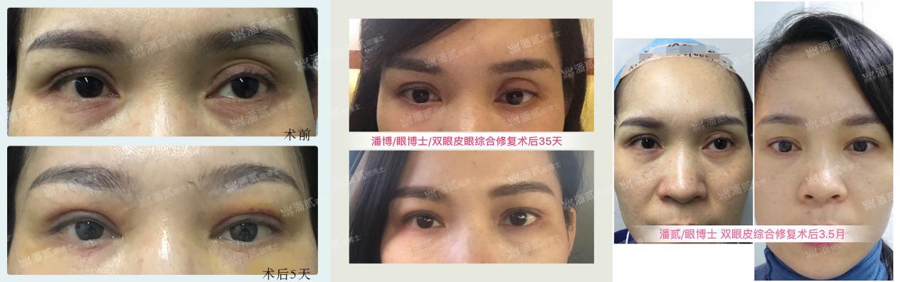 双眼皮太深显老怎么修复,双眼皮失败后修窄