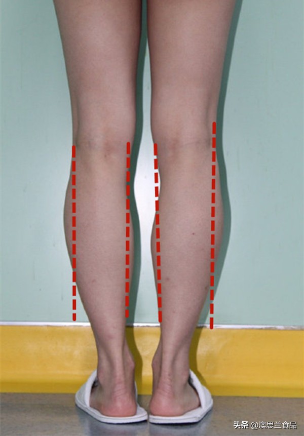 小腿肌胖怎么瘦腿,大腿肥胖小腿粗壮怎么改善