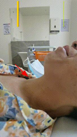 甲状腺结节微创消融手术,甲状腺结节微创消融医保